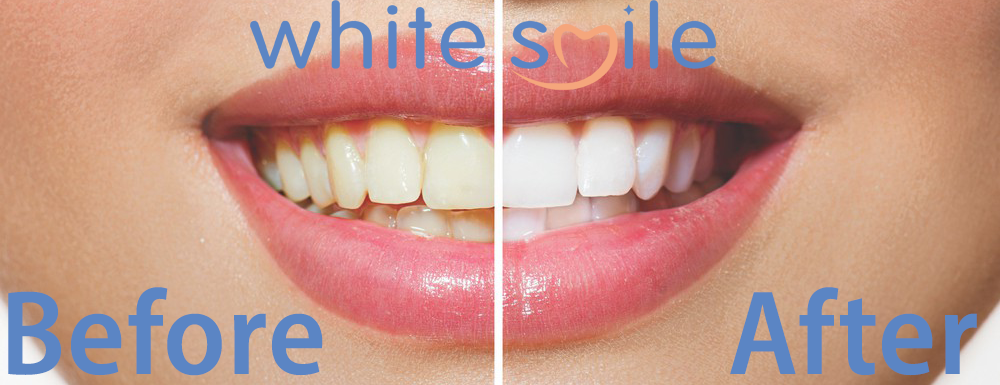 Before and After Wording